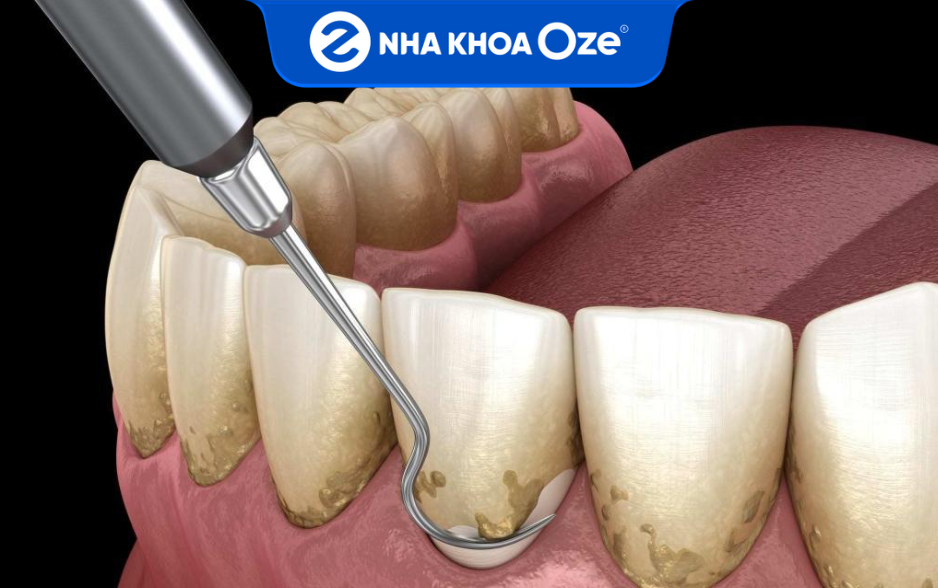 Cao răng đen chỉ có thể được xử lý bằng dụng cụ, máy móc nha khoa chuyên dụng tại các phòng khám