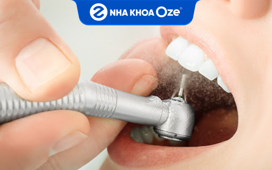 Cao răng đen được bác sĩ làm sạch với phương pháp lấy cao răng bằng máy siêu âm