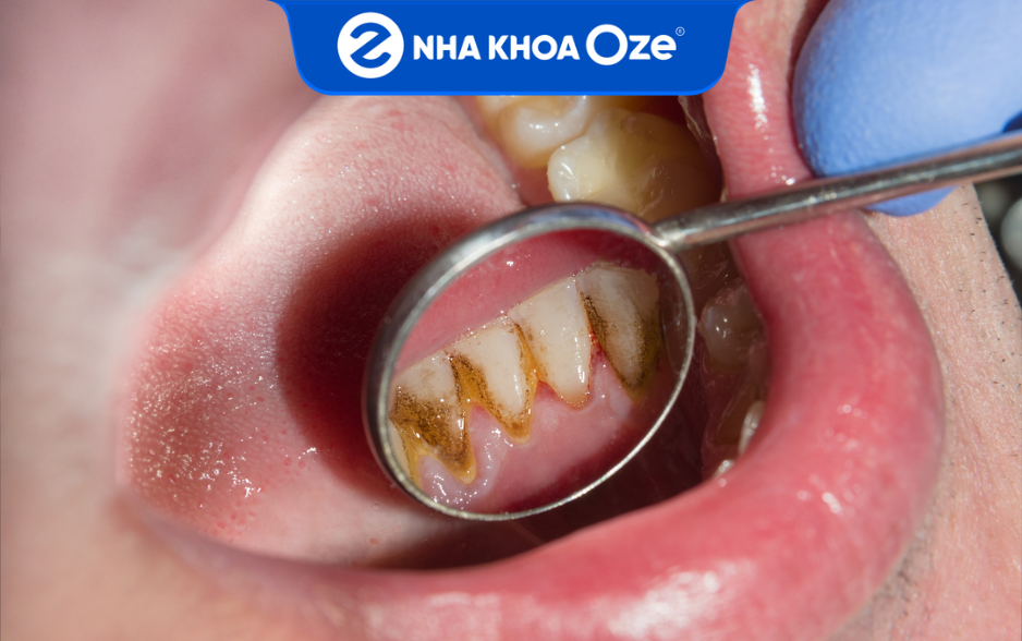 Cao răng là nỗi phiền toái của nhiều khách hàng