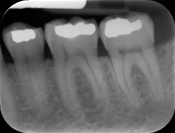 Chụp x quang quanh chóp (periapical)