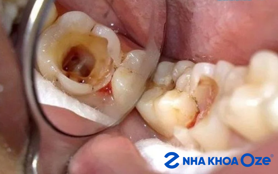 Con sâu răng được cho là nguyên nhân chính gây sâu răng