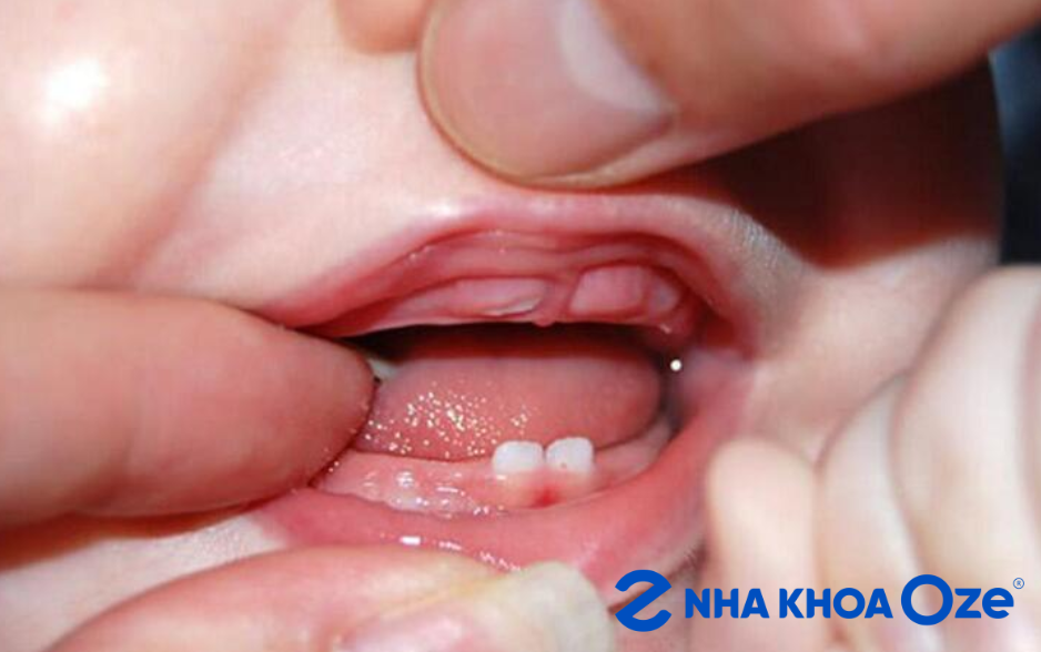 Giai đoạn mọc răng ở trẻ được tính từ khi chiếc răng sữa đầu tiên xuất hiện