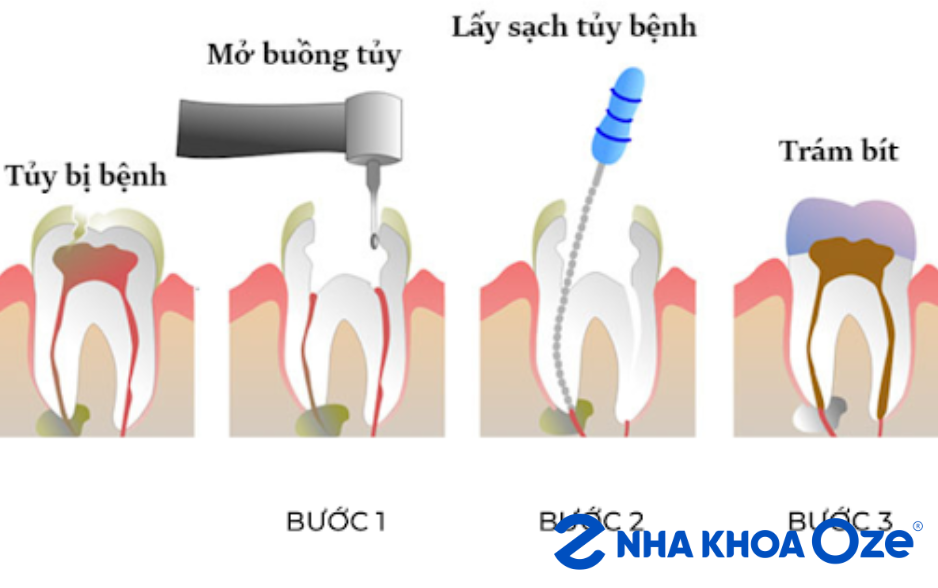 Hình ảnh các bước rút tủy răng