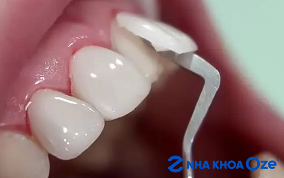 Hoàn toàn có thể tháo răng sứ đã lắp