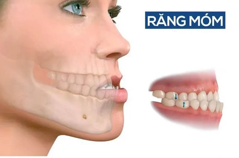 Khớp cắn ngược