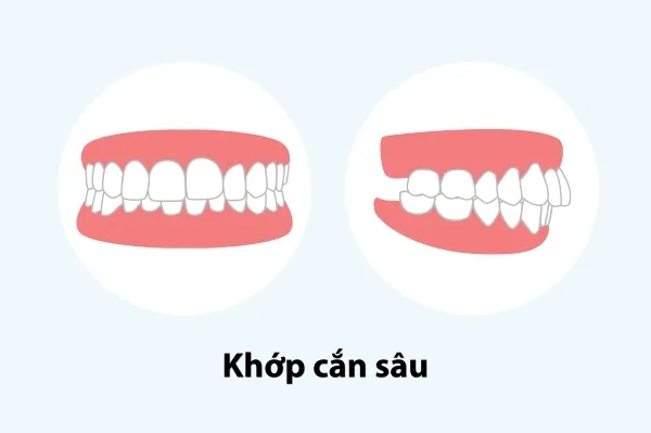 Khớp cắn sâu