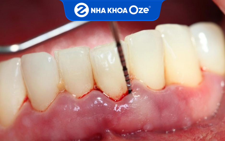 Kỹ thuật lấy cao răng không đúng sẽ làm tổn thương mô mềm nướu/lợi