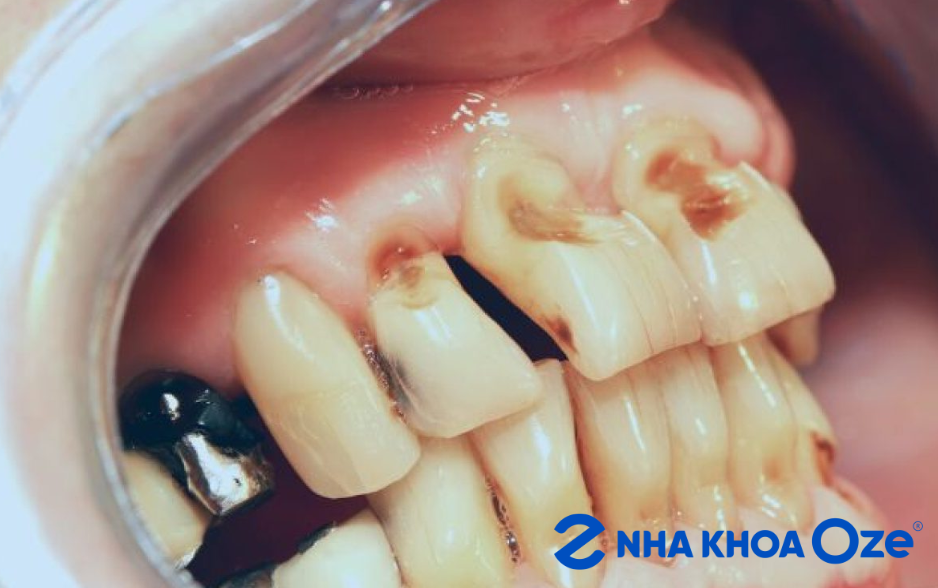 Làm mất thẩm mỹ của hàm răng