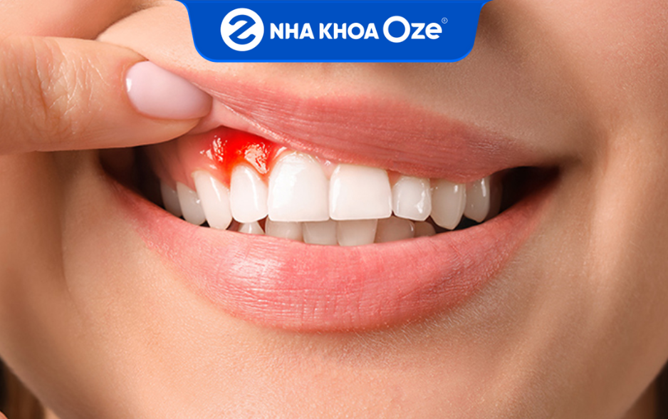 Viêm chân răng là bệnh lý về răng thường gặp và có thể xảy ra ở mọi lứa tuổi