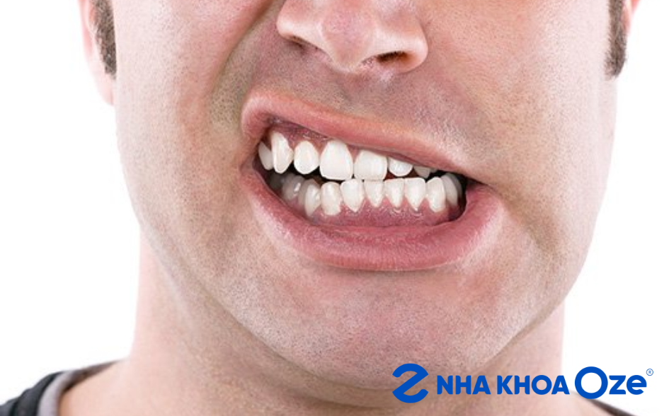 Loại bỏ thói quen nghiến răng