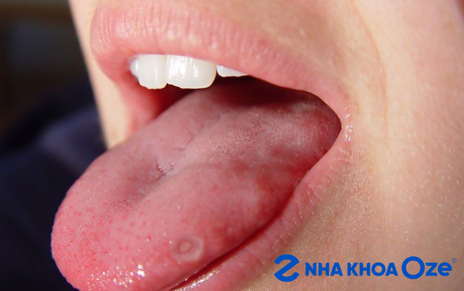 Lưỡi bị loét, sưng và đau