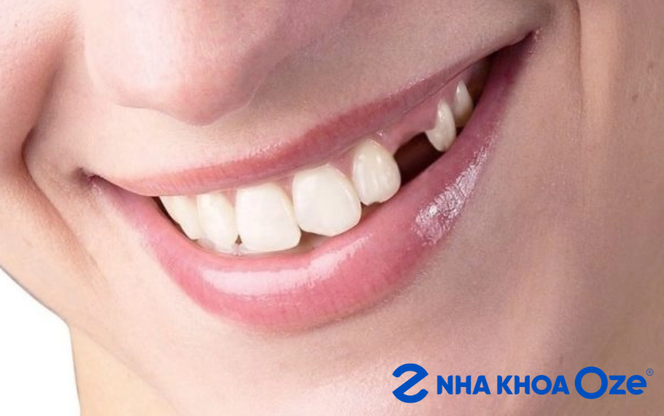 Mất răng nanh gây khó khăn trong việc ăn uống