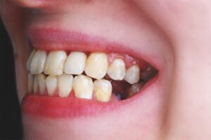Nguyên nhân răng cấm bị hư? Cách khắc phục triệt để