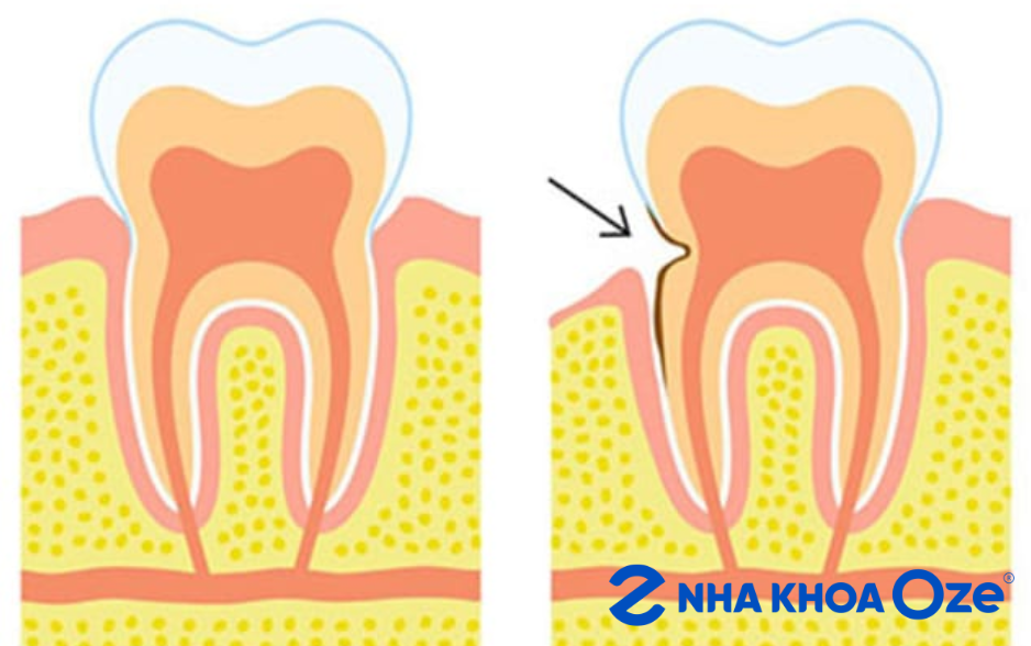 Mòn cổ răng gây tổn thương tủy răng