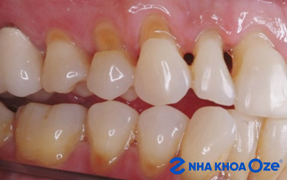 Người bệnh bị mòn cổ răng khiến răng ê buốt, khó chịu