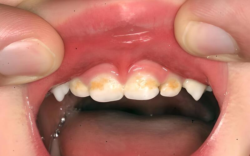 Dấu hiệu nhận biết mòn chân răng ở trẻ