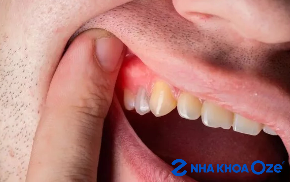 Nướu xuất hiện các khối u bất thường