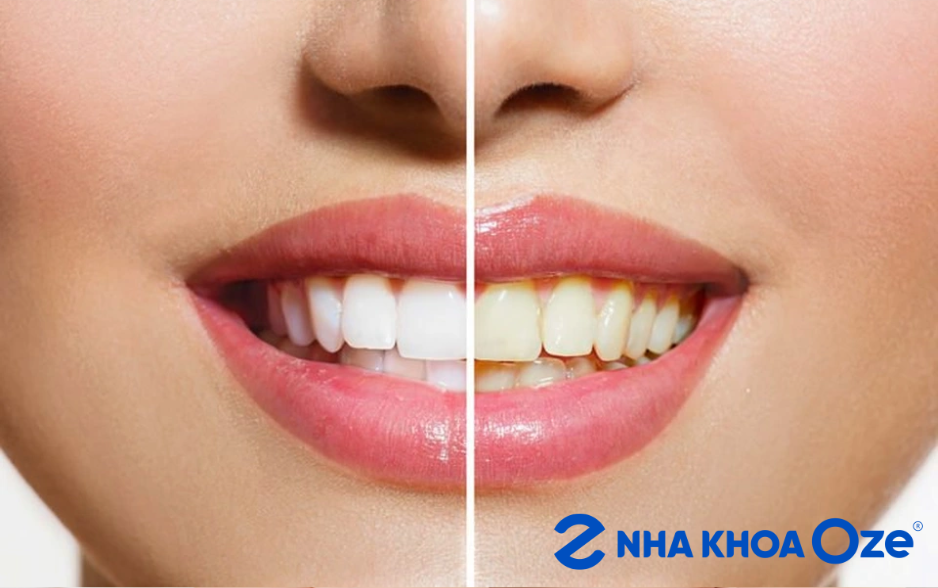 Răng ố vàng và răng trắng
