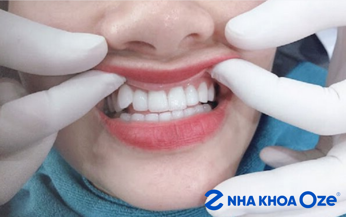 Răng khểnh đơn giản là sự sai lệch trong sắp xếp của hàm răng