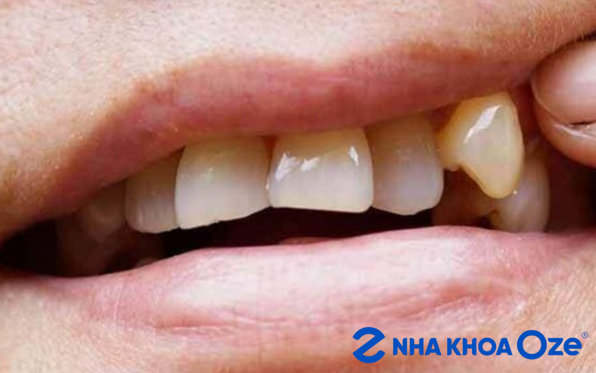 Răng khểnh gây ra một số vấn đề về bộ nhai và bệnh răng miệng