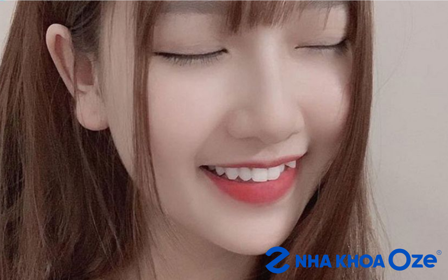 Răng khểnh đẹp phụ thuộc vào góc nhìn của từng người