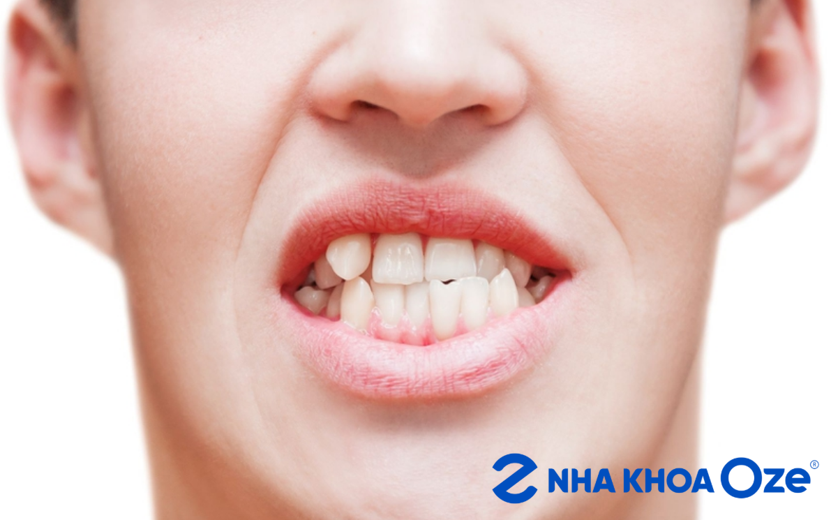Người phương Tây cho rằng răng khểnh tượng trưng cho điều xấu