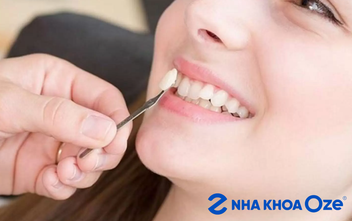 Tiết kiệm chi phí như bọc sứ cho răng khểnh vẫn mang thẩm mỹ cao