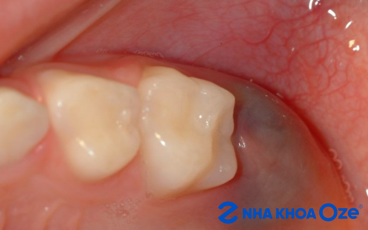 Nướu bị sưng tấy, có màu sẫm hơn bình thường