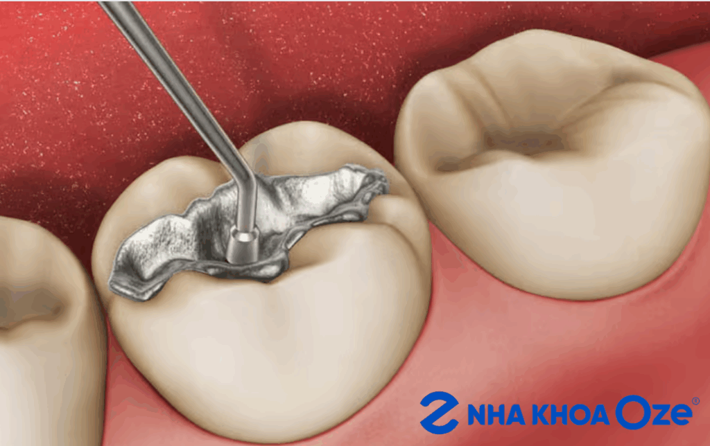 Quy trình hàn răng tại Nha khoa Oze Sóc Sơn