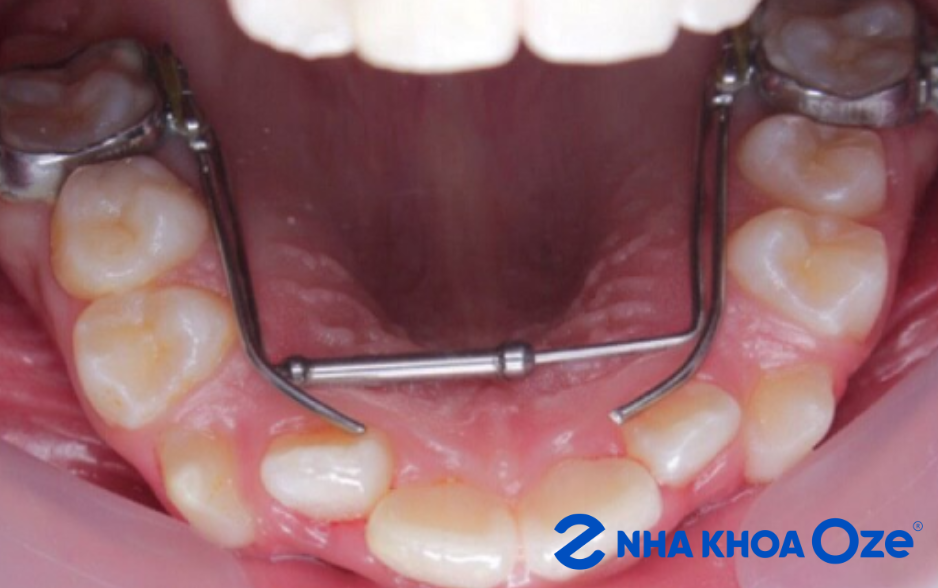 Sử dụng khí cụ để kéo răng về vị trí đúng tỷ lệ khớp cắn