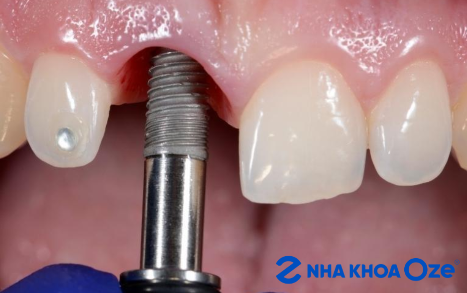 Đặt trụ implant
