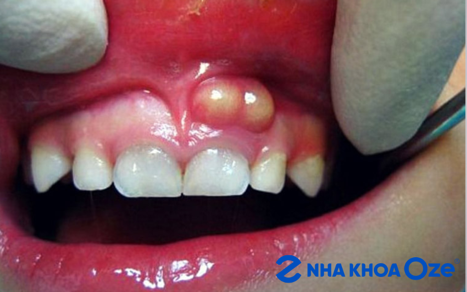 Viêm quanh răng gây ra các biến chứng áp xe răng