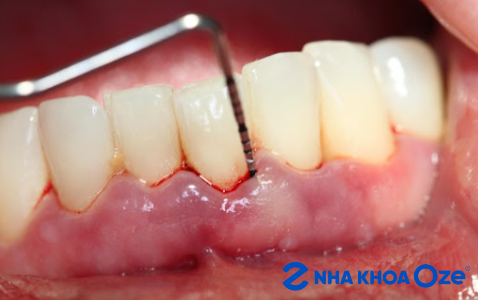 Viêm quanh răng xảy ra do một số sang chấn răng