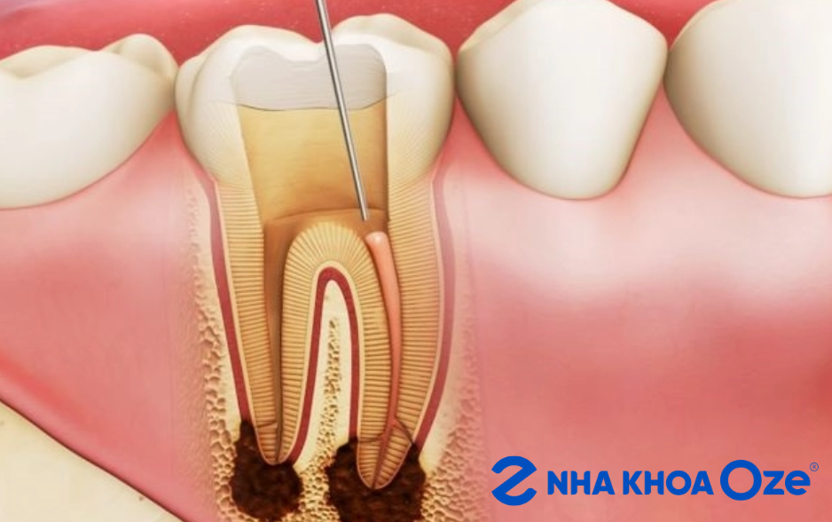 Viêm quanh răng xảy ra do sai sót trong quá trình chữa viêm tủy