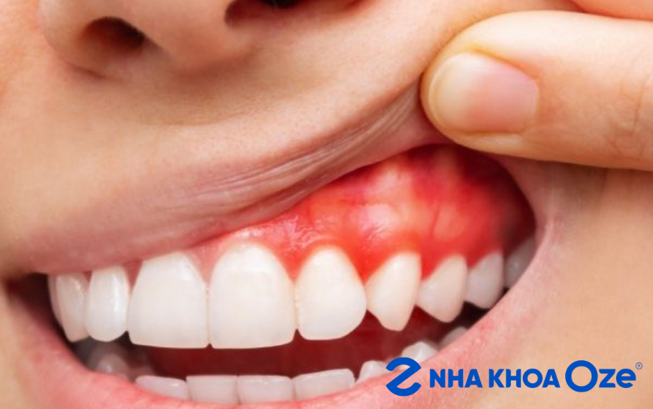 Viêm nướu là dấu hiệu khi cấy ghép Implant không tương thích