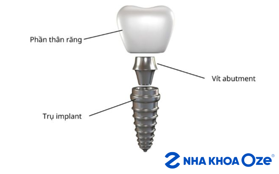Cấu tạo vật liệu trồng răng Implant