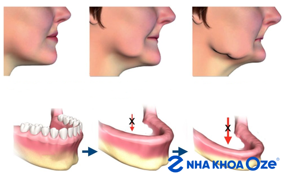 Ảnh minh họa tình trạng tiêu xương