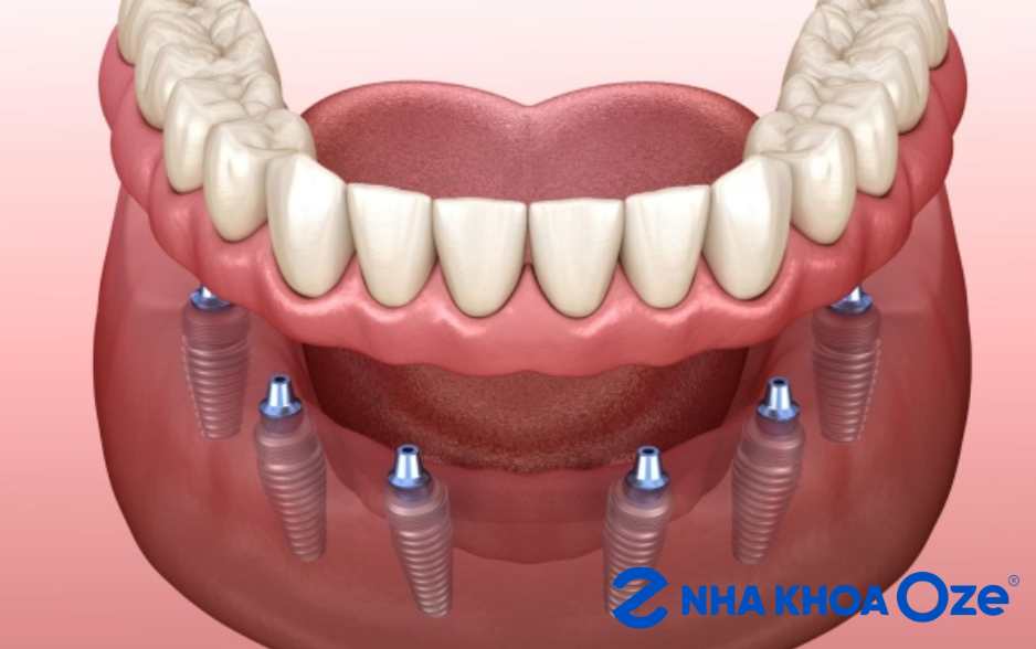 Trồng răng implant toàn hàm