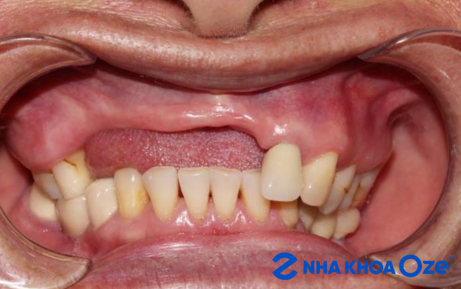 Mất răng làm giảm khả năng ăn nhai