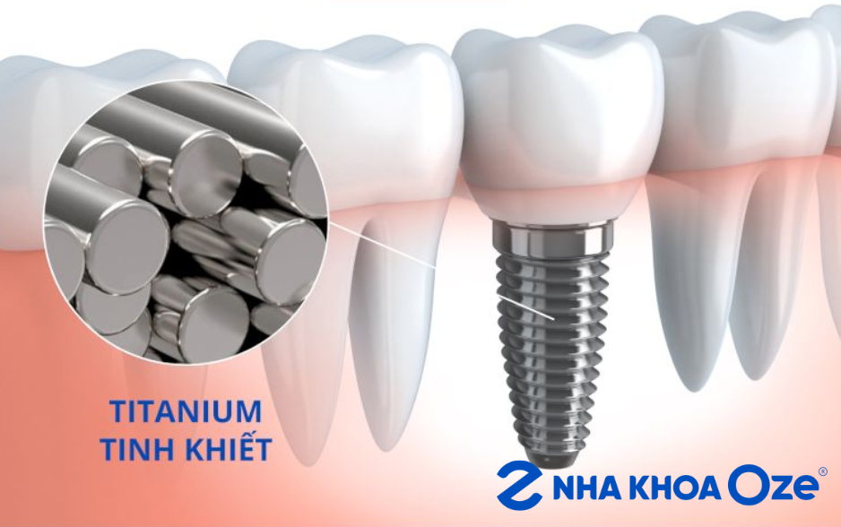 Titanium trong trồng răng Implant