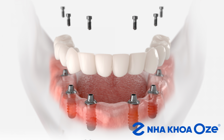 Trồng răng Implant all on 6