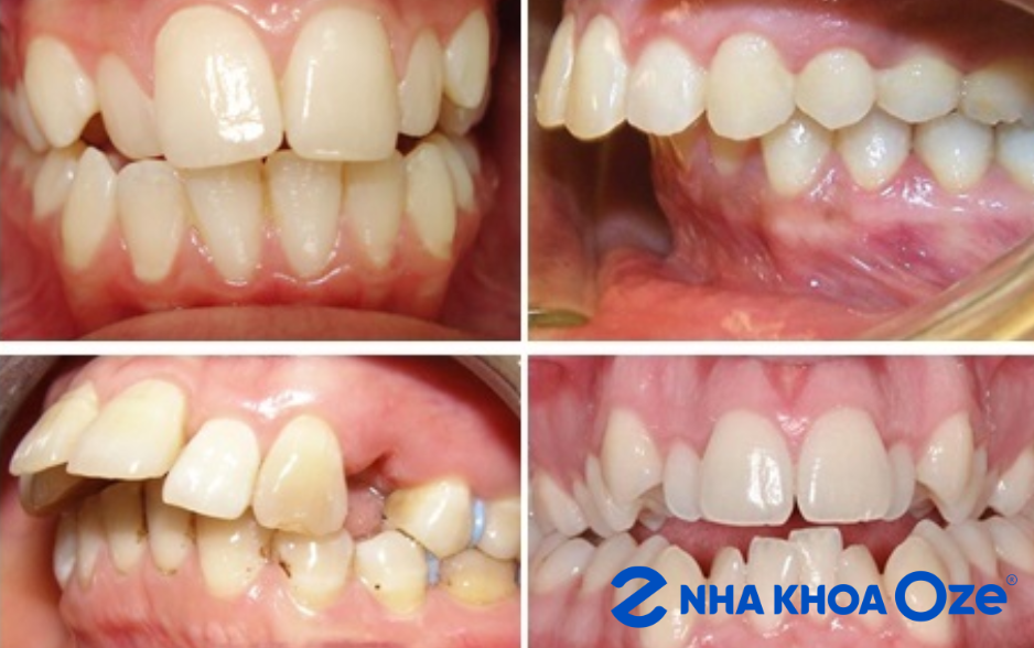 Trường hợp răng quá to, răng chèn lên, mọc xô lệch, gây răng vẩu