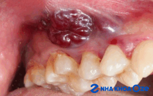 Ung thư răng chữa được không