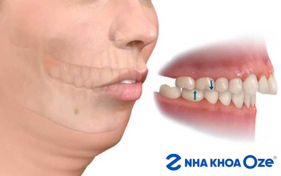 Vẩu cả răng và hàm là nặng nhất, cần được chữa trị kịp thời