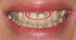 Nguyên nhân và cách khắc phục khi trồng răng giả bị lung lay