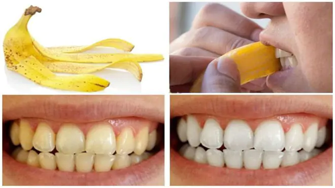 Làm trắng răng đơn giản bằng vỏ chuối tại nhà
