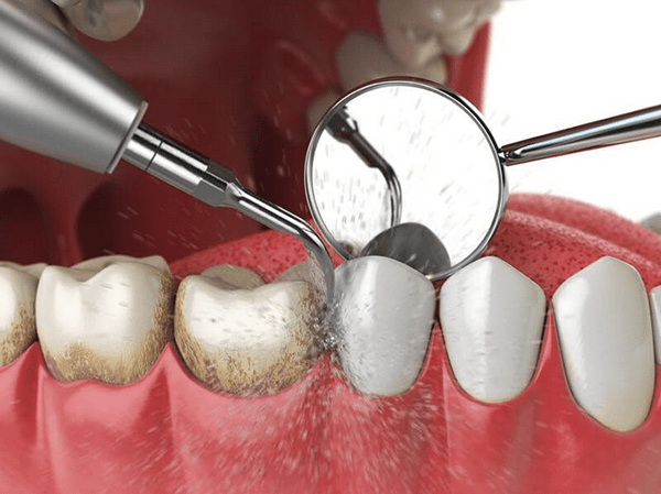 Mảng bám, cao răng (vôi răng) tạo điều kiện cho vi khuẩn trú ẩn