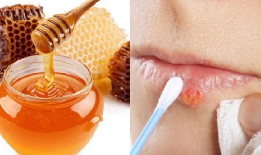 Chữa nhanh nhiệt miệng bằng mật ong