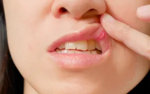 Lở miệng thiếu vitamin gì? Nên bổ sung ngăn chặn lở miệng