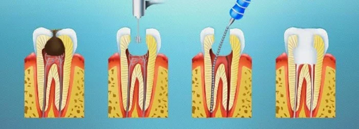 Tại sao cần lấy tủy răng